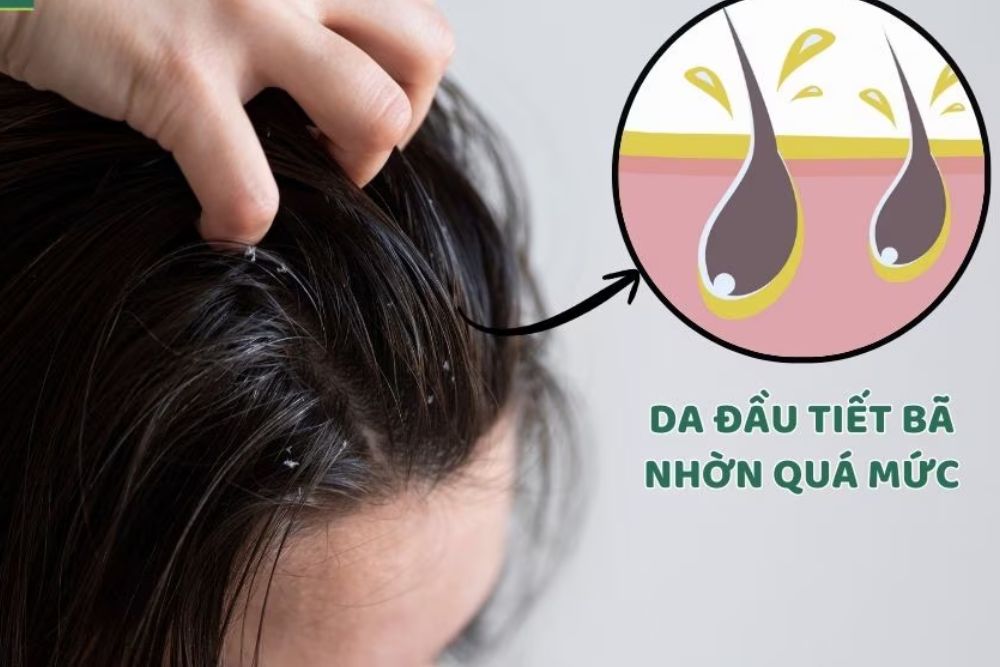 Tóc nhanh bết có thể do da đầu tiết nhiều dầu, chăm sóc chưa đúng cách hoặc sản phẩm chưa phù hợp.