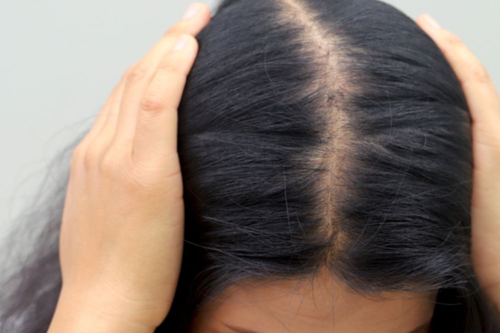 Rụng tóc ở phụ nữ trung niên có thể do nội tiết tố, thay đổi hormone khiến tóc yếu hơn, mỏng hơn và dễ gãy rụng.