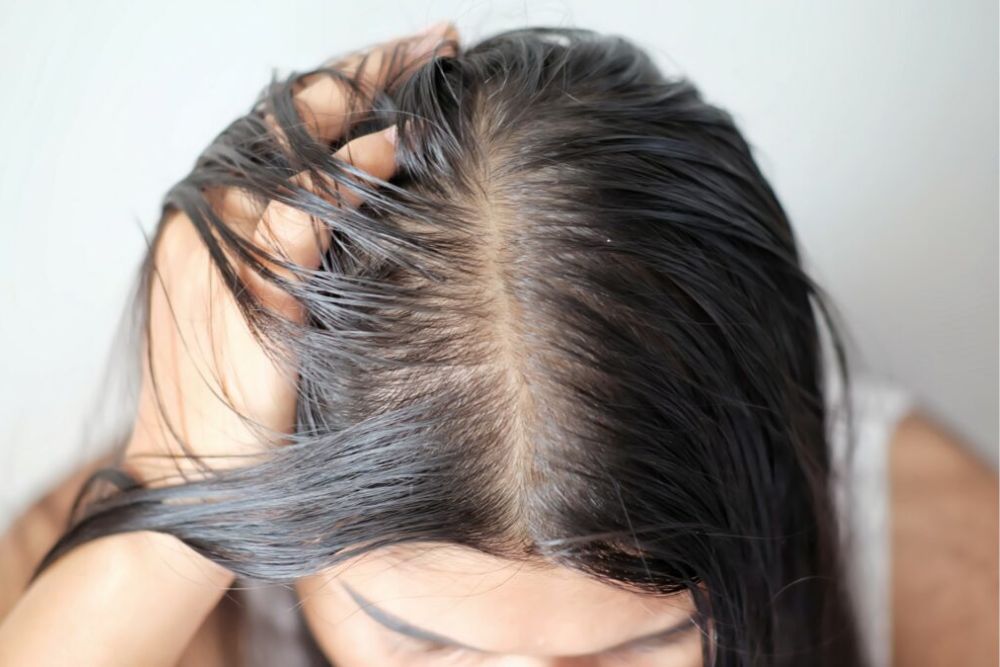 Da đầu nhiều dầu khiến tóc nhanh bết và tạo điều kiện cho gàu hình thành.