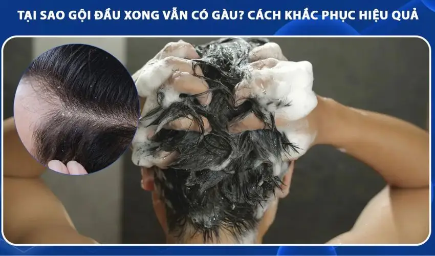 Tại sao gội đầu xong vẫn có gàu? Nguyên nhân và cách khắc phục